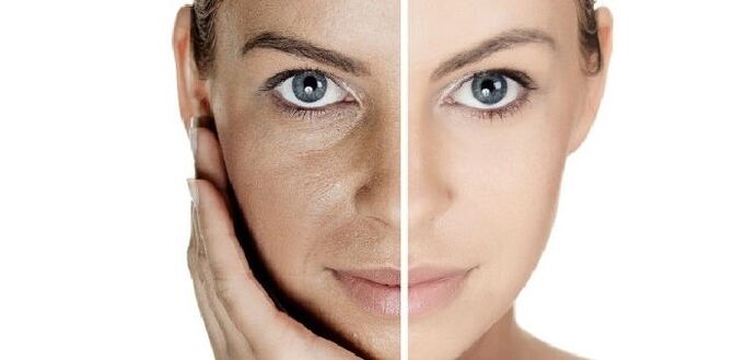 sebelum dan selepas peremajaan kulit wajah