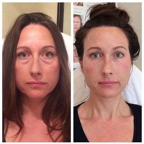 Gadis sebelum dan selepas peremajaan wajah laser