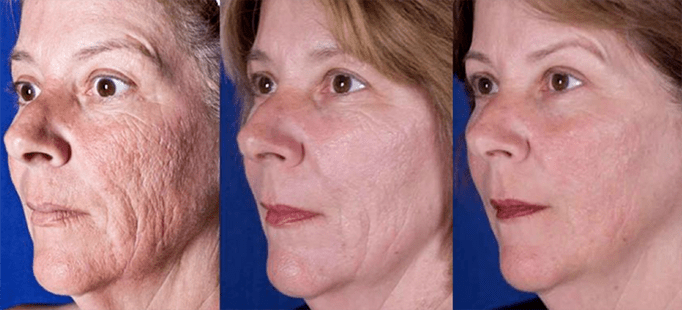 Hasilnya selepas prosedur peremajaan kulit wajah laser