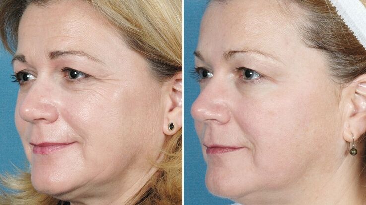 gambar sebelum dan selepas peremajaan kulit perkakasan