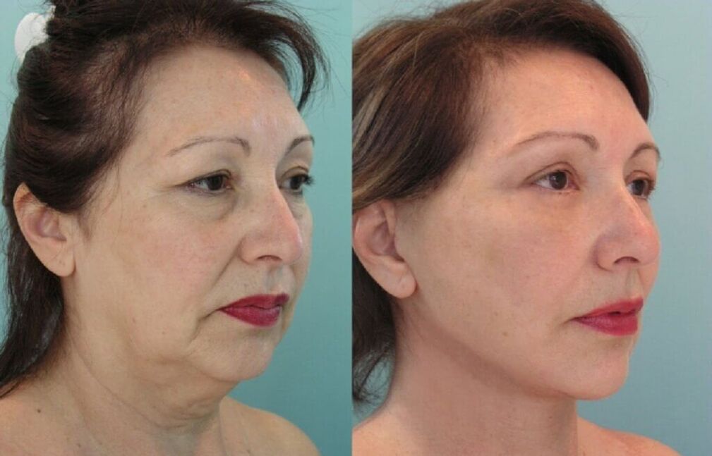 gambar sebelum dan selepas peremajaan kulit