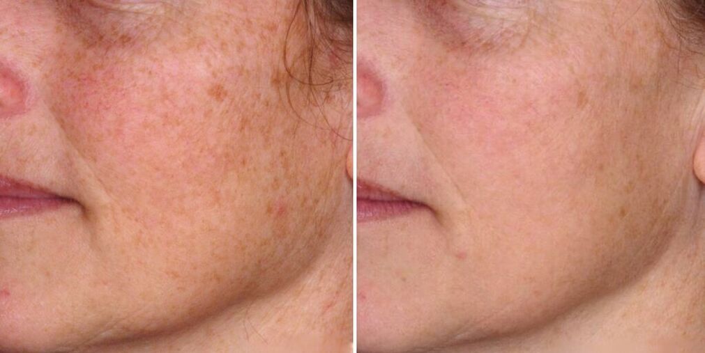 kulit muka sebelum dan selepas peremajaan